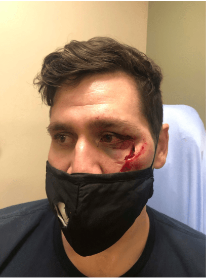 Shawn Murphy sued Denver and Aurora police over an facial injury caused by police projectiles used on protesters in Denver in 2020. (Photo provided by Baumgartner Law)